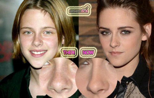 Kristen Stewart Nose Job Before After
