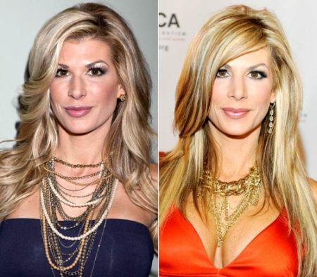 Alexis Bellino nose job before after