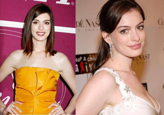 Anne Hathaway Plastic Surgery