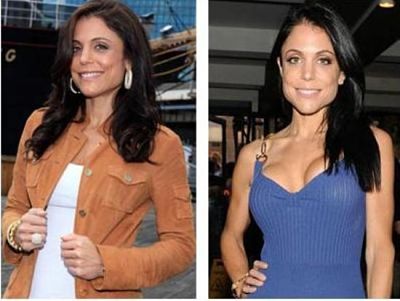 Bethenny Frankel plastic surgery before and after
