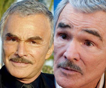 Burt Reynolds plastic surgery before and after