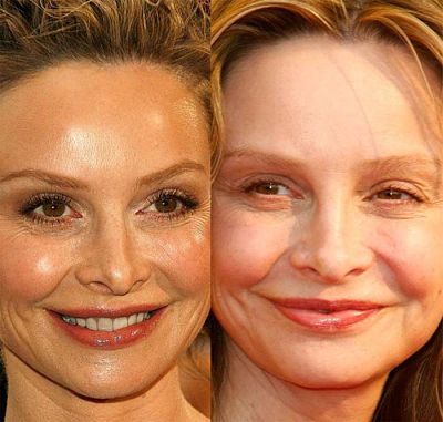 Calista Flockhart Plastic Surgery before and after