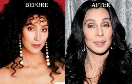 Cher botox injections