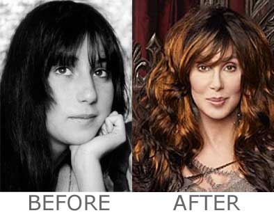 Cher plastic surgery before and after