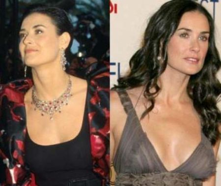 Demi Moore Breast Implants Before After