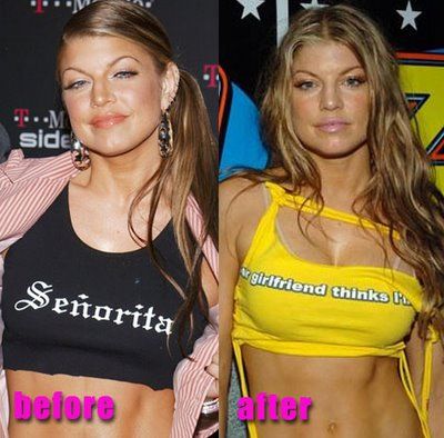 Fergie breast implants before and after