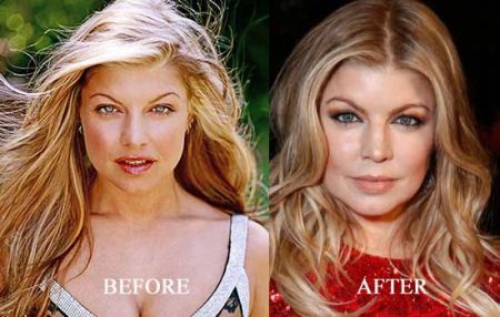 Fergie nose job