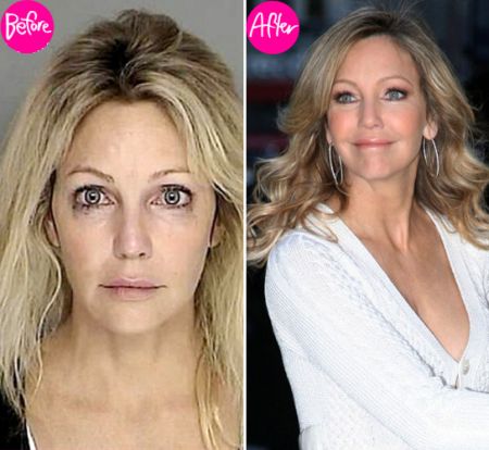 Heather Locklear plastic surgery before & after