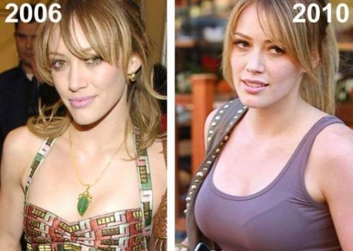Hilary Duff Plastic Surgery Before and After