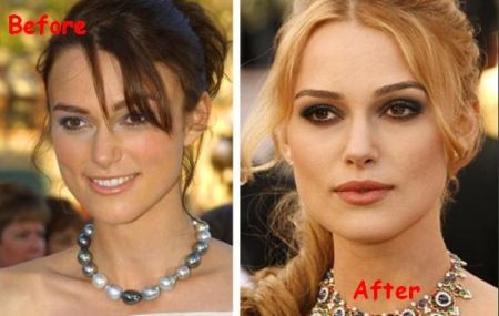 Keira Knightley plastic surgery before and after