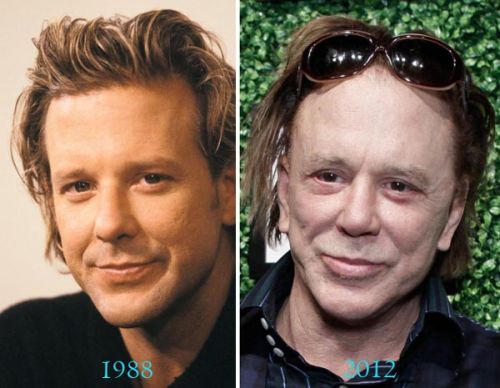 Mickey Rourke plastic surgery before & after