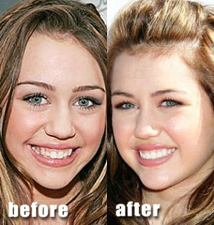Miley Cyrus nose job before and after