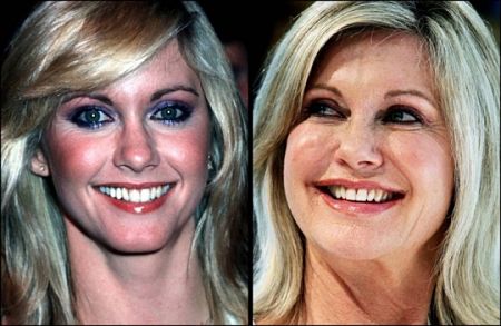 olivia newton john plastic surgery before and after