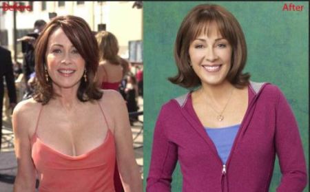 Patricia Heaton Plastic Surgery Before and After
