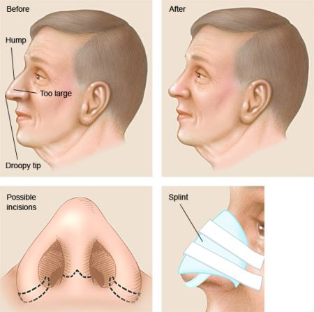 Rhinoplasty procedure