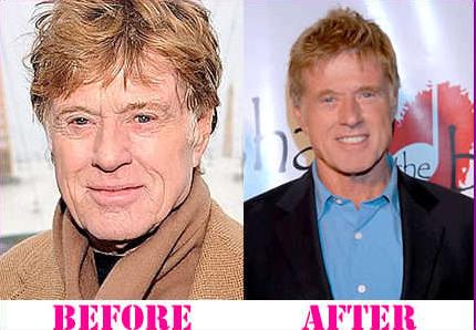 Robert Redford plastic surgery before and after