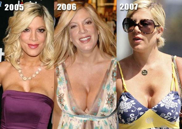 Tori Spelling breast implants gone bad