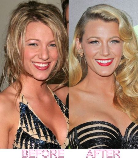 Blake Lively plastic surgery before and after