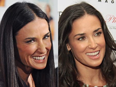 Demi Moore plastic surgery before and after