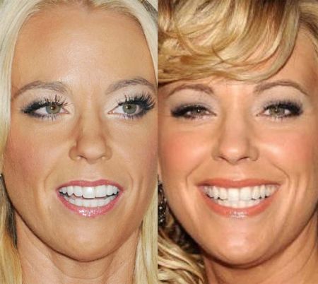 Kate Gosselin plastic surgery before and after