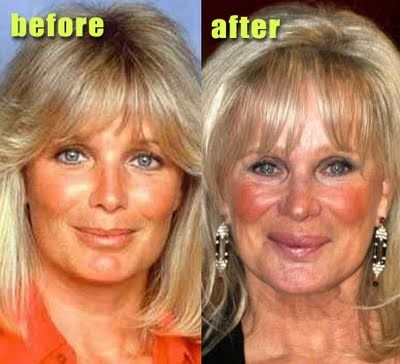 Linda Evans plastic surgery before and after