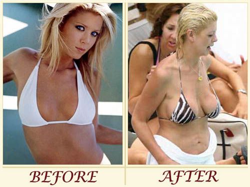 Tara Reid plastic surgery before and after