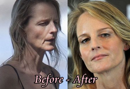 Helen Hunt plastic surgery before after