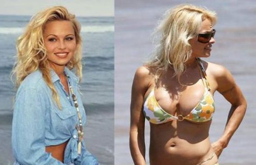 Pamela Anderson Breast Implants Before and After