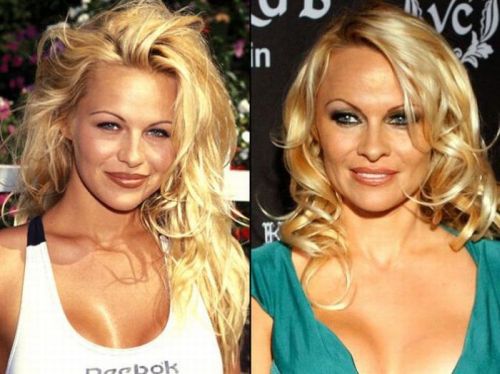 Pamela Anderson Plastic Surgery Before After