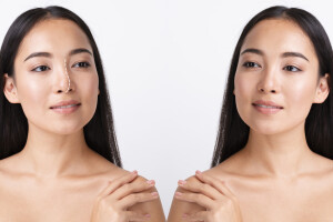 Rhinoplasty Recovery: Tips for a Smooth Healing Process