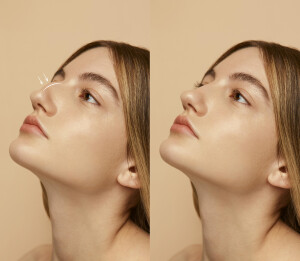 Nose Job Cost: Budgeting for a Beautiful New Nose
