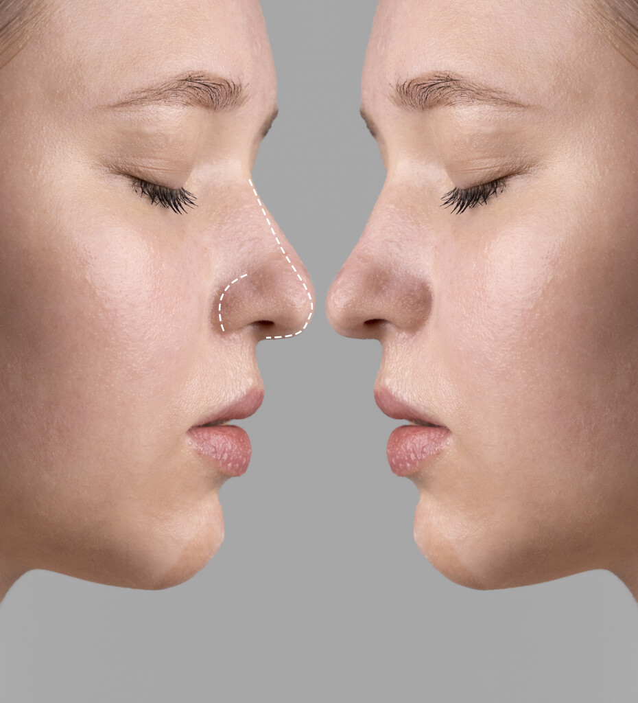 nose plastic surgery before and after